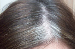 Grey hair | Dr Aditis Advanced Homeopathy