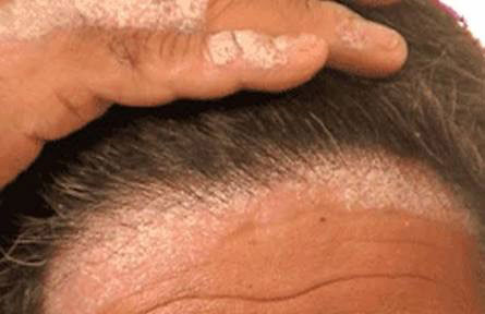 Psoriasis of Scalp | Dr Aditis Advanced Homeopathy